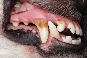 Stade 2 Maladie parodontale précoce